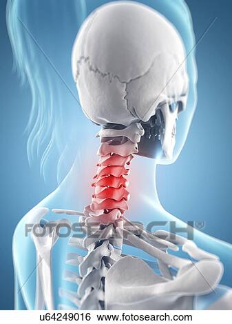 Human neck pain, artwork View Large Illustration Stock Illustration - Human neck pain, artwork. Fotosearch