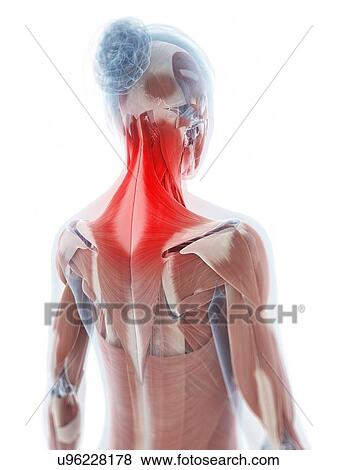 Stock Illustration - Human neck pain, artwork. Fotosearch