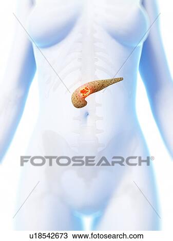 Human pancreas showing tumor, artwork View Large Illustration Drawing - Human pancreas showing tumor, artwork. Fotosearch