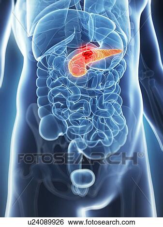 Human pancreas showing tumor, artwork View Large Illustration Stock Illustration - Human pancreas showing tumor, artwork. Fotosearch