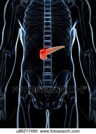 Human pancreas showing tumor, artwork View Large Illustration Stock Illustration - Human pancreas showing tumor, artwork. Fotosearch