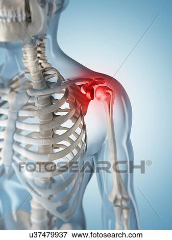 Human shoulder pain, artwork View Large Illustration Stock Illustration - Human shoulder pain, artwork. Fotosearch