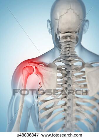 Stock Illustration - Human shoulder pain, artwork. Fotosearch