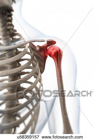 Stock Illustration - Human shoulder pain, artwork. Fotosearch