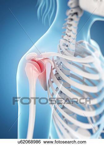 Stock Illustration - Human shoulder pain, artwork. Fotosearch