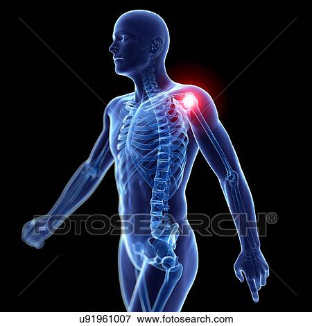 Human shoulder pain, artwork View Large Illustration Stock Illustration - Human shoulder pain, artwork. Fotosearch