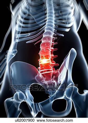 Human spine with slipped disc, artwork View Large Illustration Clipart - Human spine with slipped disc, artwork. Fotosearch