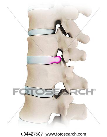 Human spine with slipped disc, artwork View Large Illustration Stock Illustration - Human spine with slipped disc, artwork. Fotosearch