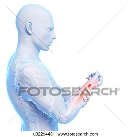 Human wrist pain, artwork View Large Illustration Clip Art - Human wrist pain, artwork. Fotosearch