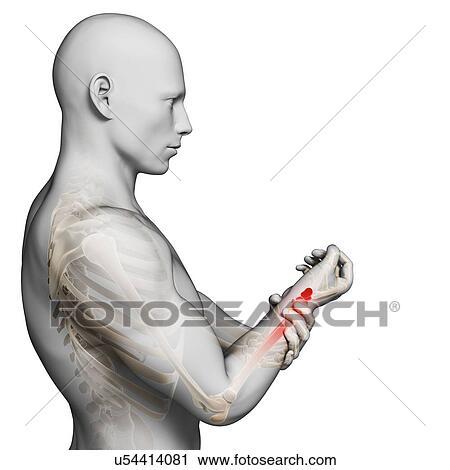 Clip Art - Human wrist pain, artwork. Fotosearch