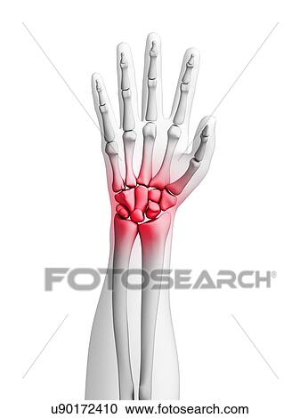 Human wrist pain, artwork View Large Illustration Clipart - Human wrist pain, artwork. Fotosearch