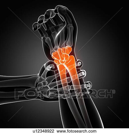 Human wrist pain, artwork View Large Illustration Drawing - Human wrist pain, artwork. Fotosearch