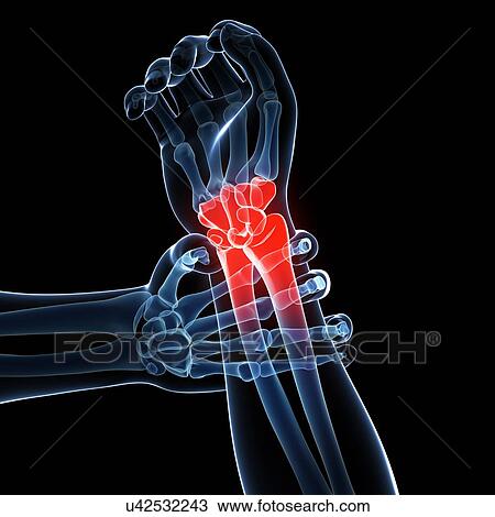 Drawing - Human wrist pain, artwork. Fotosearch