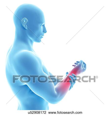 Human wrist pain, artwork View Large Illustration Drawing - Human wrist pain, artwork. Fotosearch