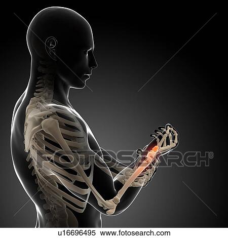 Stock Illustration - Human wrist pain, artwork. Fotosearch