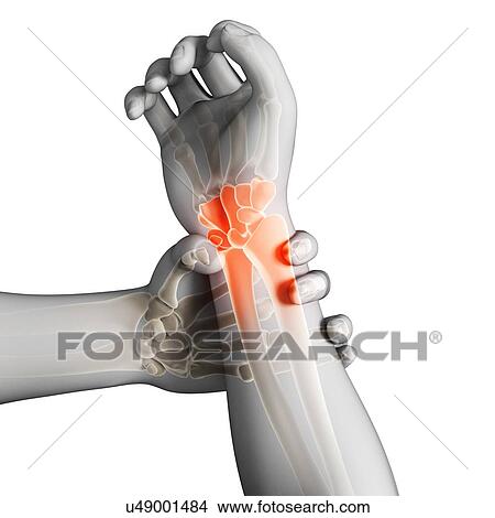 Stock Illustration - Human wrist pain, artwork. Fotosearch