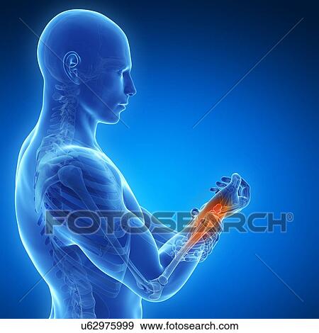 Human wrist pain, artwork View Large Illustration Stock Illustration - Human wrist pain, artwork. Fotosearch