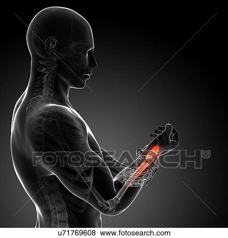 Stock Illustration - Human wrist pain, artwork. Fotosearch
