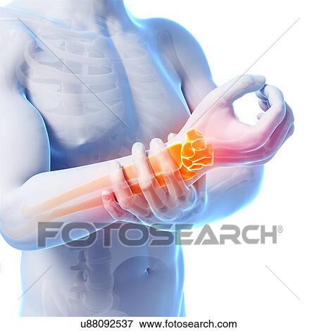 Stock Illustration - Human wrist pain, artwork. Fotosearch