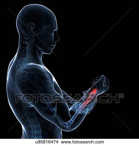 Stock Illustration - Human wrist pain, artwork. Fotosearch