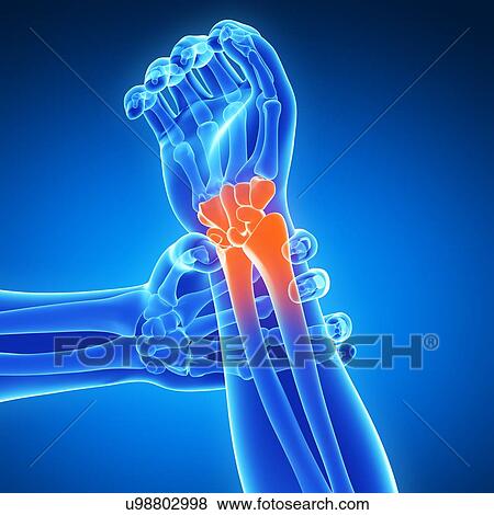 Human wrist pain, artwork View Large Illustration Stock Illustration - Human wrist pain, artwork. Fotosearch