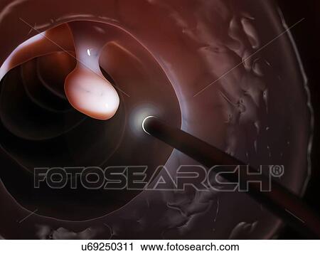 Polyp found during a colonoscopy, artwork View Large Illustration Clip Art - Polyp found during a colonoscopy, artwork. Fotosearch