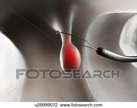 Polyp removal, artwork View Large Illustration Drawing - Polyp removal, artwork. Fotosearch