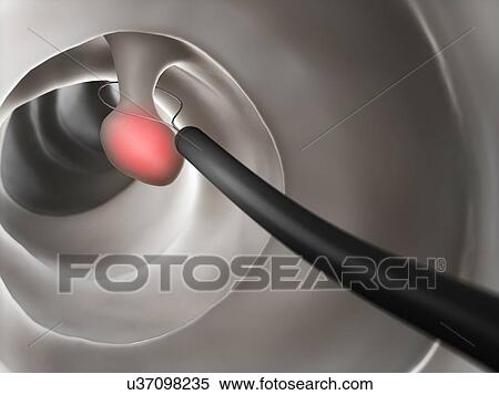Polyp removal, artwork View Large Illustration Stock Illustration - Polyp removal, artwork. Fotosearch