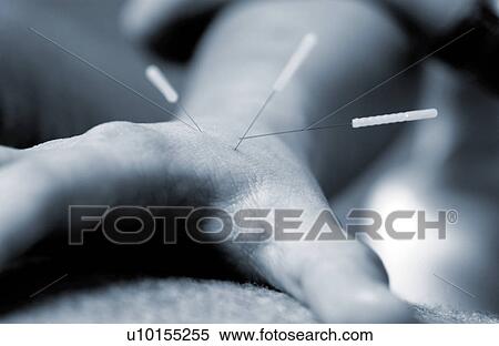 Stock Photography - Person receiving acupuncture. Fotosearch