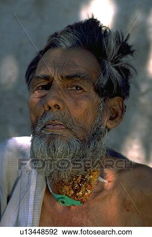 carbide, india, union, victim, gas, bhopal View Large Photo Image Stock Image - carbide, india, union, victim, gas, bhopal. Fotosearch