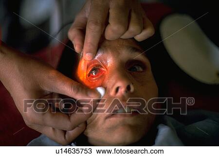 worlds, hand, victim, survivor, bhopal, medical View Large Photo Image Stock Image - worlds, hand, victim, survivor, bhopal, medical. Fotosearch