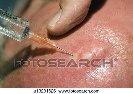 head, local, syringe, needle, anaesthetic, injection View Large Photo Image Stock Photograph - head, local, syringe, needle, anaesthetic, injection. Fotosearch