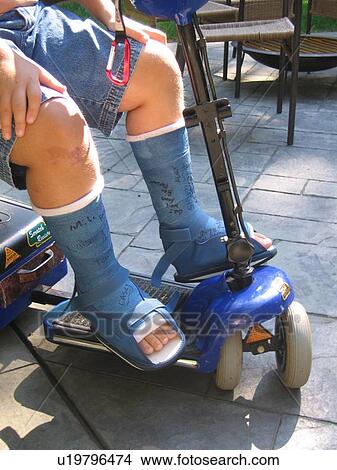 Boy, with Muscular Dystrophy, in casts. View Large Photo Image Picture - Boy, with Muscular Dystrophy, in casts.. Fotosearch