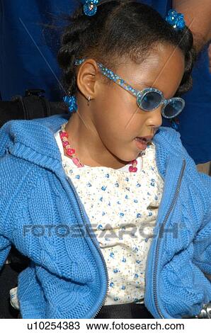 Stock Image - Beautiful face of a little girl with a disability.. Fotosearch