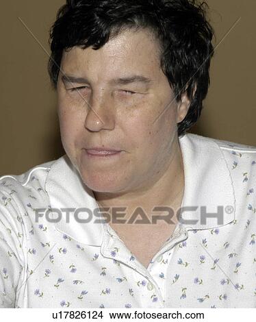 Woman with a visual impairment/blindness. View Large Photo Image Picture - Woman with a visual impairment/blindness.. Fotosearch