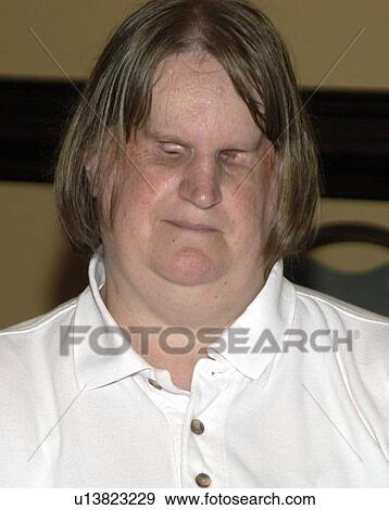 Stock Photo - Woman with a visual impairment/blindness.. Fotosearch