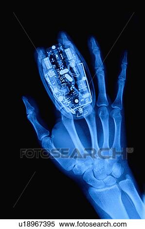X-ray Image View Large Photo Image Stock Photography - X-ray Image. Fotosearch