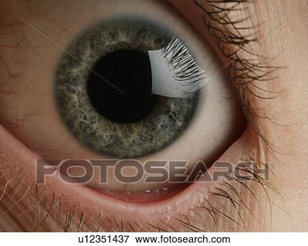 Stock Photo - Distorted eye. Fotosearch