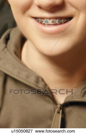 Child with braces View Large Photo Image Stock Photo - Child with braces. Fotosearch