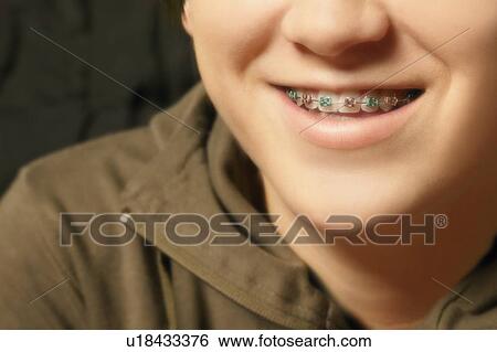 Stock Photograph - Child with braces. Fotosearch