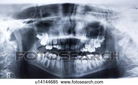Stock Photography - Panoramic dental tooth x-ray - new teeth growing. Fotosearch