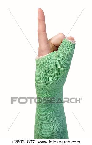 Stock Photo - Arm in a cast. Fotosearch