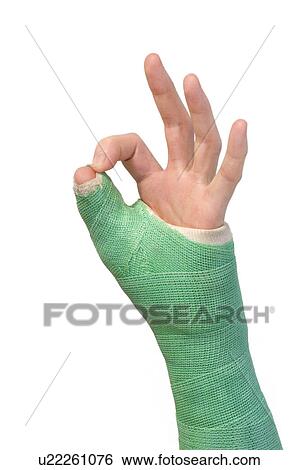 Arm in a cast View Large Photo Image Stock Photograph - Arm in a cast. Fotosearch