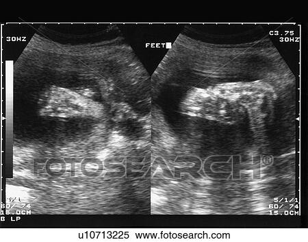 Stock Photography - Pregnancy scan. Fotosearch