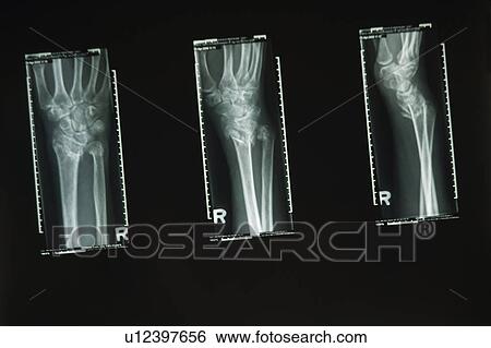 Three x-rays of a wrist View Large Photo Image Stock Photograph - Three x-rays of a wrist. Fotosearch