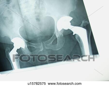 Stock Photography - X-ray of a hip replacement. Fotosearch