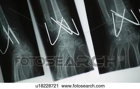 X-ray of pins in a wrist View Large Photo Image Stock Image - X-ray of pins in a wrist. Fotosearch