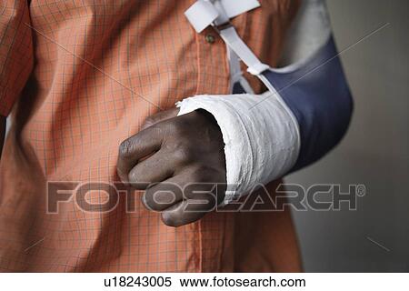 Man with broken arm close-up of cast View Large Photo Image Stock Photography - Man with broken arm close-up of cast. Fotosearch