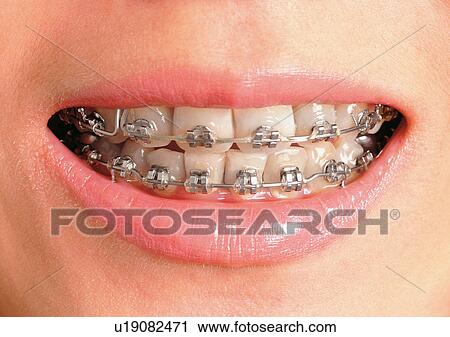 Stock Image - Braces, Chin, Close-Up, Facial Expression. Fotosearch
