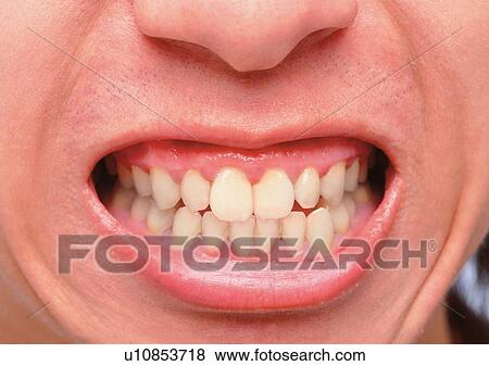Braces, Chin, Close-Up, Facial Expression View Large Photo Image Stock Photo - Braces, Chin, Close-Up, Facial Expression. Fotosearch